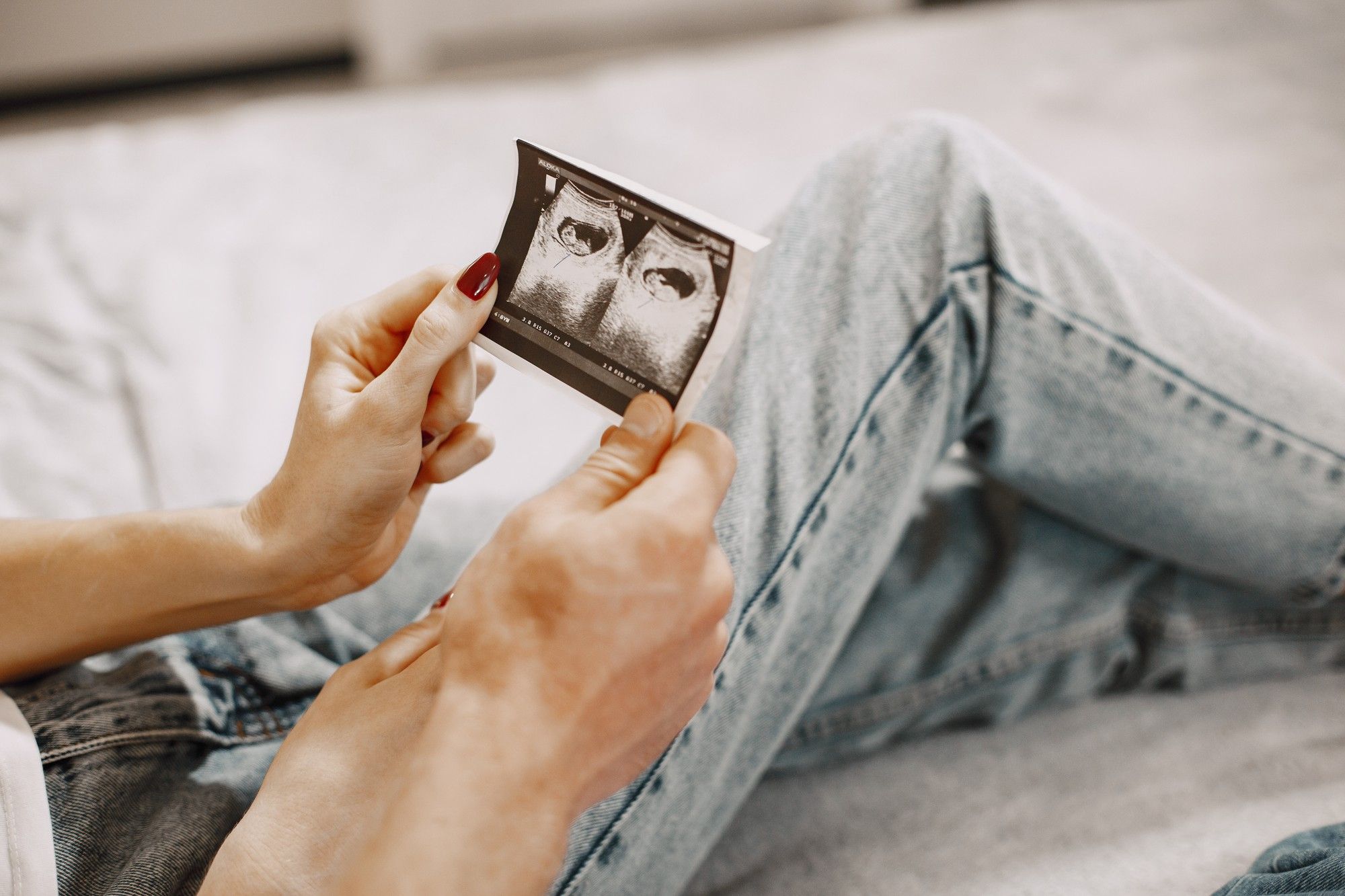 PRP terapija kod tankog endometrijuma – mit ili stvarna nada za implantaciju?